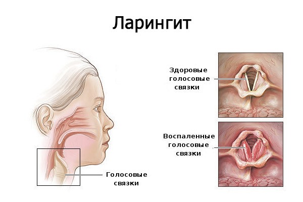 Что такое ларингит