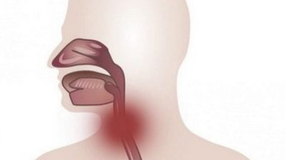 Что такое ларингофарингеальный рефлюкс: все о заболевании