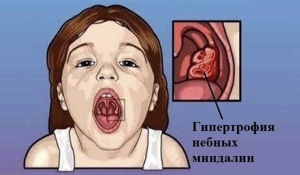Увеличение миндалин у детей