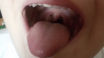 Увеличенные миндалины (гипертрофия) у взрослых и детей