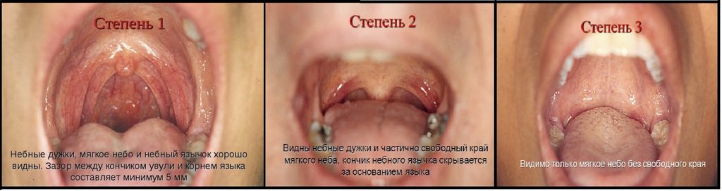Гипертрофия небных миндалин - степени