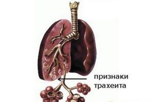 Кашель при трахеите