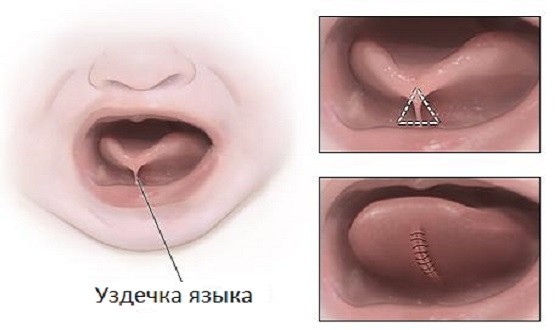Подрезание короткой уздечки