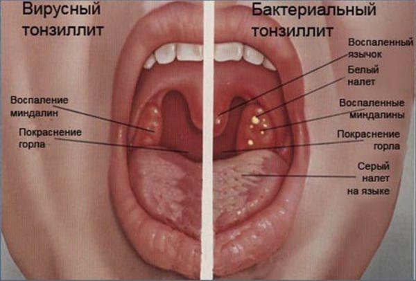 Отличие вирусного тонзилита Отличие вирусного тонзилита