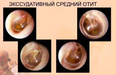 Экссудативный отит стадии