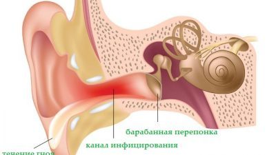 Как у ребенка диагностировать и вылечить гнойный отит?