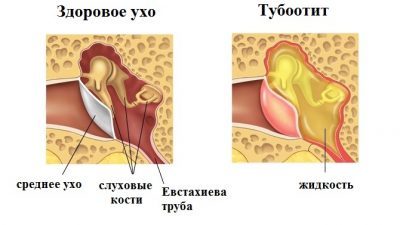 Современные методы лечения тубоотита у ребенка