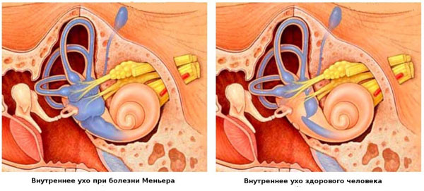 ухо здорового и болезнь меньера