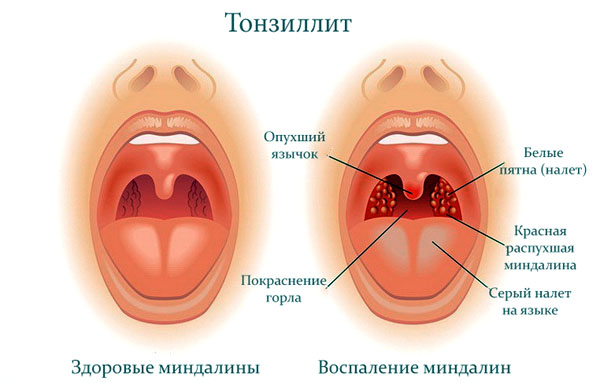 Ангина без температуры