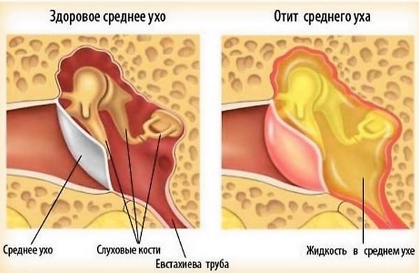 Как выглядит отит