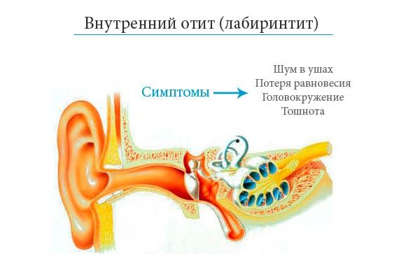Симптомы отита