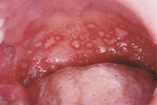 gerpesnay-angina-1.jpg