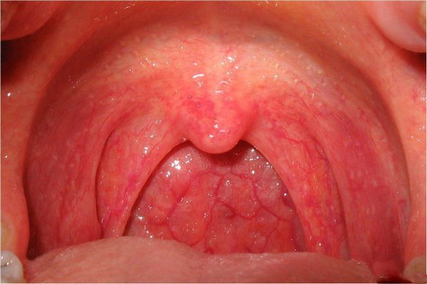 kataralnay-angina-2.jpg